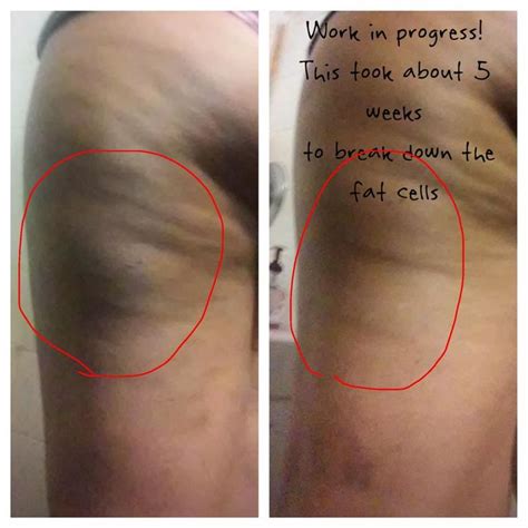 fascia blasting results|Fascia blasting: The real science behind the trend .